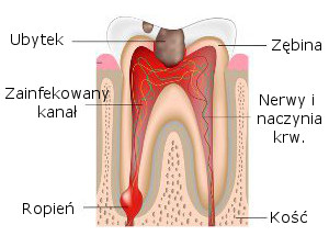 Leczenie Kanalowe