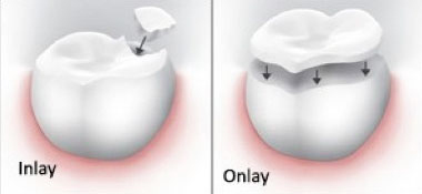 inlays-onlays