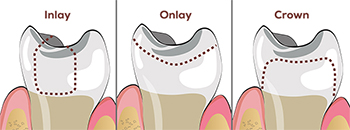 inlays-onlays