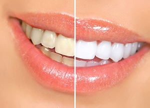 teeth sandblasting