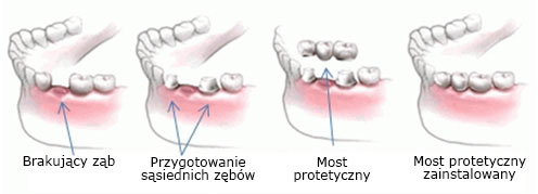Mosty Dentystyczne